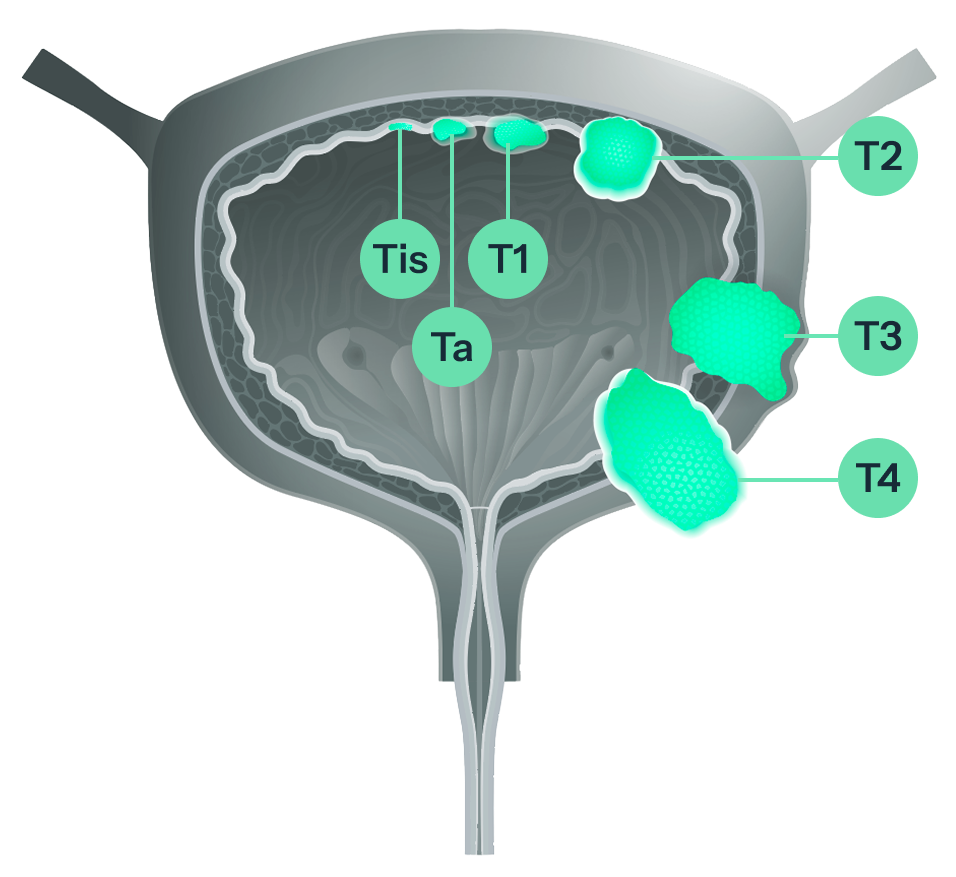 Diagram and text detailing bladder cancer stages: NMIBC (Stage 0, 1) and MIBC (Stage 2, 3, 4), with visual tumor representations.